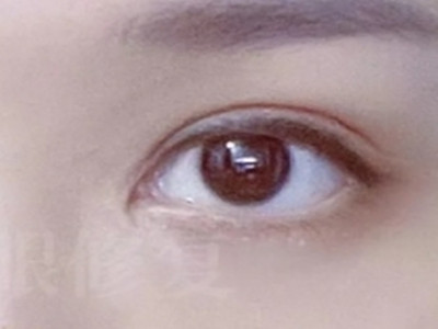 惊艳蜕变！双眼皮整形让眼睛会说话