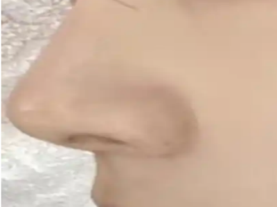 硅胶隆鼻怎么做