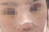 手术当天，医生帮我把鼻子里填充的假体给取出来