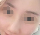 术后15天，这段时间为了让鼻子恢复的更好一些