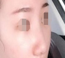我的鼻子现在变得如此美丽，鼻子的精致度让我很满意
