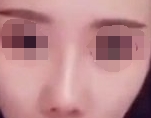 术后90天，鼻子的变化是比较细微