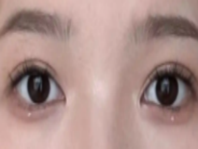 祛眼袋的三种整形美容方法