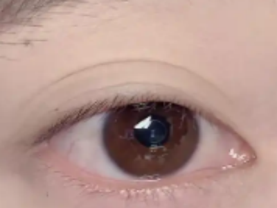 切开双眼皮的适应人群