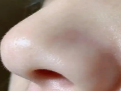 出现了黑头要不要挤？怎么搞定