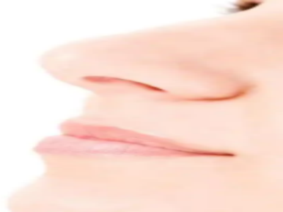 鹰钩鼻矫正手术使鼻子恢复一个正常立体的状态