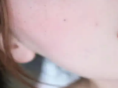 想祛除雀斑，做一次项目要花多少钱