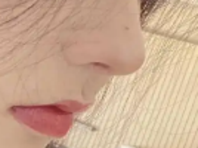 无需手术的美丽：打针隆鼻