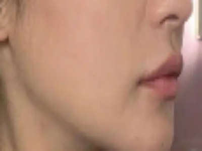 磨颧骨整形，展现出女性特有的魅力