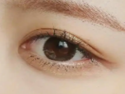 三角眼”的形成根源：不止是眼皮松弛