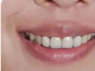 烤瓷牙适合什么人群？我们今天来看看自己适不适合做这个项目