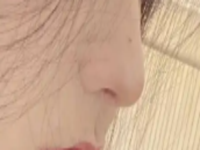 科普：耳软骨用来做隆鼻之后会再生吗