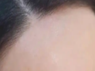 发际线脱毛要多久才可以彻底不长