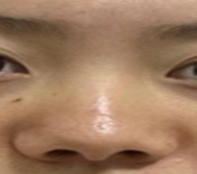 从塌鼻梁到自然妈生鼻，我的隆鼻重生记