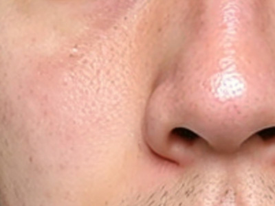 夏秋换季痘肌危机？痘肌不必自闭