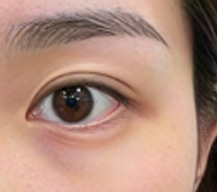 一直对自己单眼皮不太满意的求美者