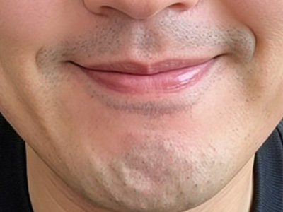 下巴不美观，自带“憨厚”气质怎么办？