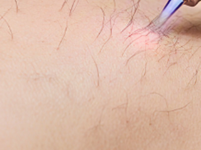 深色皮肤人群激光脱毛安全吗？这些真相你必须知道