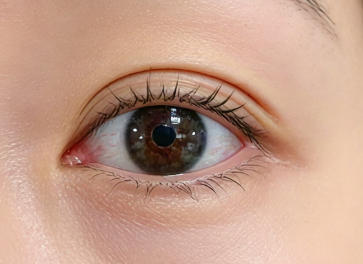 告别“耷拉眼”，重拾自信笑容