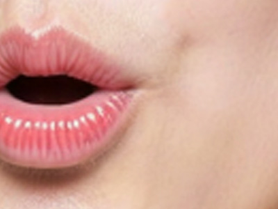 嘴角纹埋线提升后，剧烈运动要“踩刹车”吗