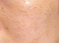 术后三天，皮肤有点泛红