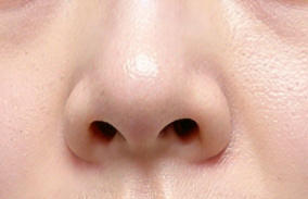 隆鼻材料怎么选？耳软骨与肋软骨深度解析助你变美