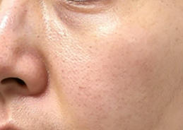 生完孩子后，我的苹果肌明显下垂