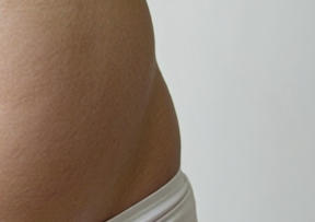 告别“腰”虑，重塑自信曲线—一位求美者的蜕变故事