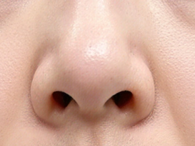二次鼻翼缩小修复避坑指南：科学修复才能告别“无效返工”