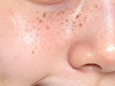 告别斑点焦虑！科学识斑+淡斑，解锁无瑕美肌