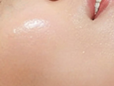 光子嫩肤：打工人的“肌肤救星”还是“智商税”