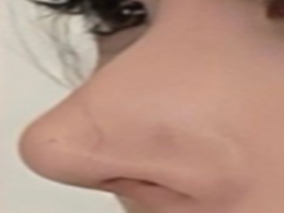 告别鼻孔缩小后僵硬感！医美自然风设计，让鼻部重焕灵动之美