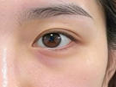 告别“眼袋包袱”不用愁！超全祛眼袋攻略助你选