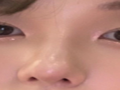 从“欧美鼻”到“妈生鼻”：鼻翼缩小审美变迁下的科学选择指南