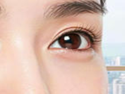 别让“青春小烦恼”拖垮眼周颜值！早留意早改善攻略来啦