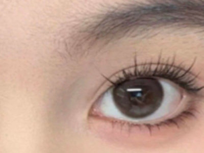 32岁女性适合做的整形项目：眼部抗衰强化版/眼综合+眶隔释放改善眼袋泪沟