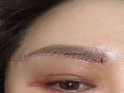 沙医生医院田艳丽医生：提眉术抗衰精雕，重塑年轻眉眼轮廓