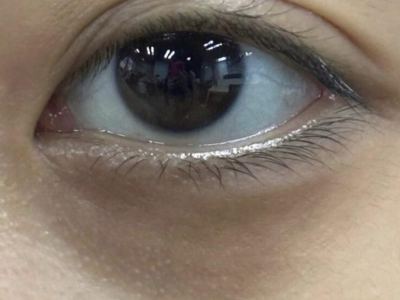 如何分辨自己的黑眼圈？黑眼圈怎么改善？