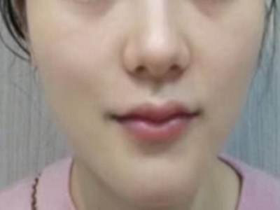 如何避免脂肪填充后“馒化脸”？掌握这几个细节，你也能自然变美