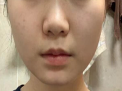 瘦脸大抉择：面吸还是注射？选对逆袭，选错毁容！