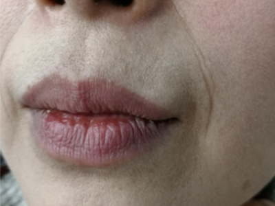 口周老化有哪些表现？怎么做好口周抗衰？