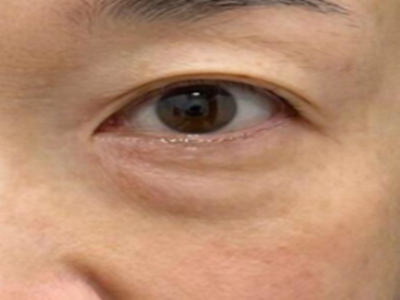 上海做眼袋哪个医生好？口碑技术双在线的医生赶紧看