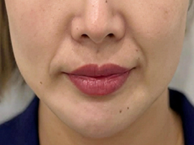 填充法令纹用什么方法好？医美塑形对症选更自然