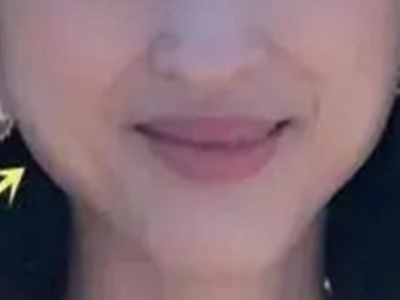 为什么很多人年纪轻轻脸就已经发腮，变方了？