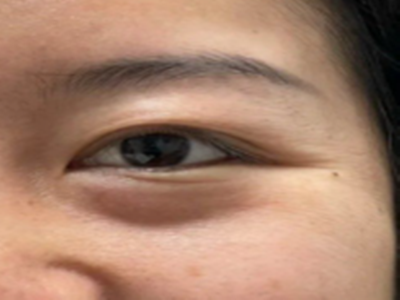 抗衰不踩坑！大连沙医生张建光：六合一祛眼袋，你的年轻密码