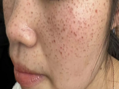 上海激光祛斑哪家医院好？前五医院排名严选