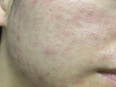 长沙黄金微针别乱选！正规机构 + 认证医生，毛孔痘坑一次见真章