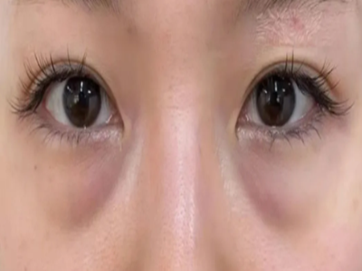 眼袋是怎么形成的？眼袋怎么消除？