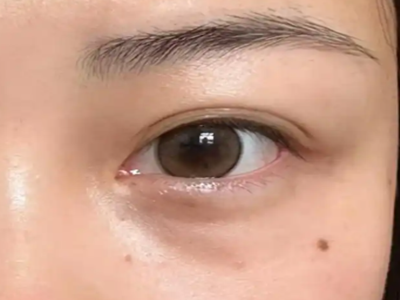 有眼袋怎么消除？去除眼袋的比较快的方法有哪些？