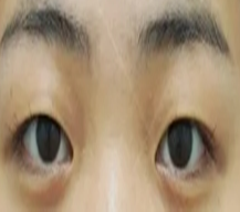做完双眼皮后放电眼魅力迷人